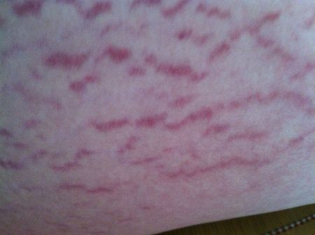 肥胖纹是怎么形成的，肥胖纹形成原因（肥胖纹是怎么产生的）