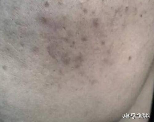 痘印痘坑如何修复，脸上的痘坑痘印如何修复（针对痘印、痘疤相关建议）