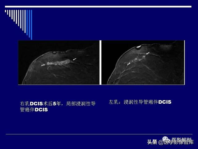 乳房解剖学基础知识，乳腺解剖及乳腺各病变影像诊断与鉴别