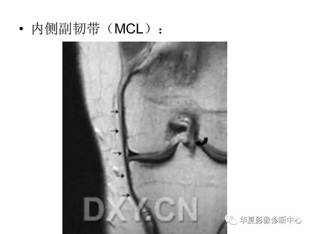 膝关节解剖结构图，膝盖解剖图示意图（膝关节MRI之正常解剖综述）