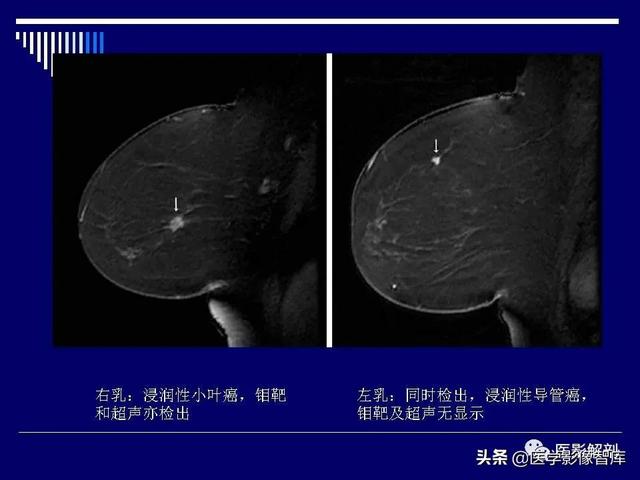 乳房解剖学基础知识，乳腺解剖及乳腺各病变影像诊断与鉴别