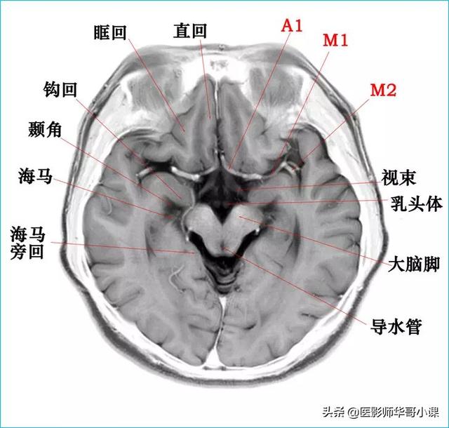 头颅ct解剖图,头部骨骼结构图(颅脑磁共振mri解剖结构以及高清图谱)