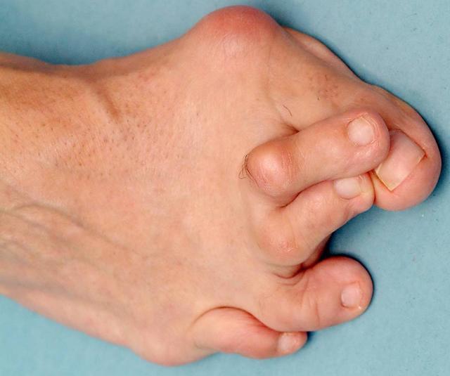 大拇脚趾比其他脚趾短(大脚趾拇最长) - 美客网