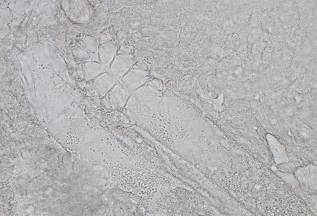 满虫咬皮肤是什么样子求图，螨虫咬的包是啥样子（3看轻松判断脸上是有螨虫）