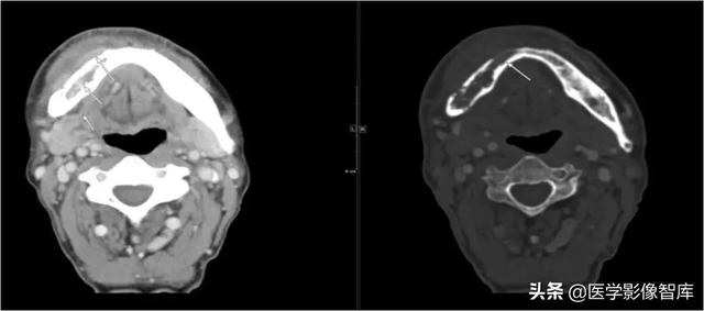 颞间隙感染，颞间隙感染切开部位（颌面部间隙感染影像诊断及各间隙解剖介绍）
