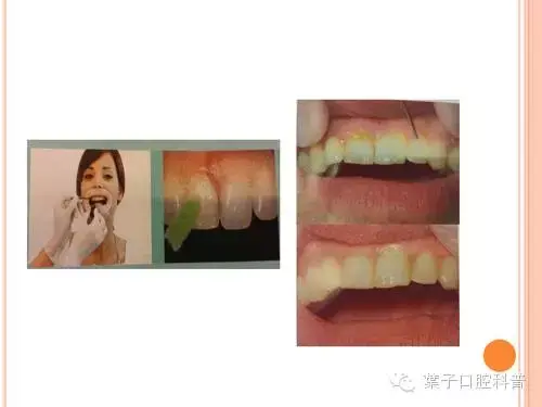 氟对牙齿的作用，含氟牙膏对牙齿的作用（有牙就要开始涂氟）