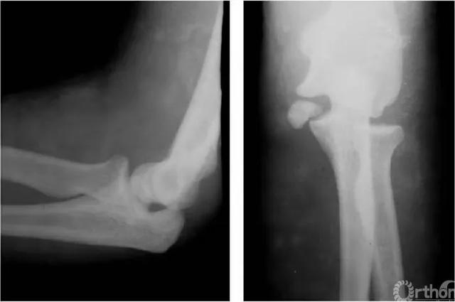 肱骨长是什么意思，骨科常见疾病X线解析之肱骨内髁骨折