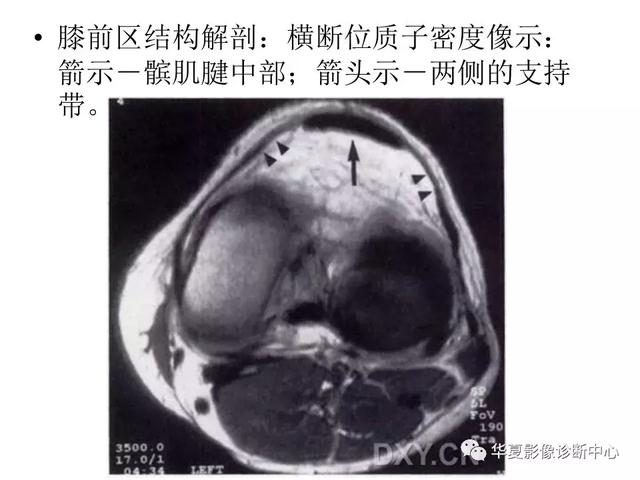 膝关节解剖结构图，膝盖解剖图示意图（膝关节MRI之正常解剖综述）