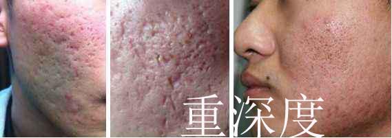 痘坑一辈子都不会好吗，激光祛痘印痘坑多少钱一次（能否选择‘’无恢复期‘’的治疗项目）