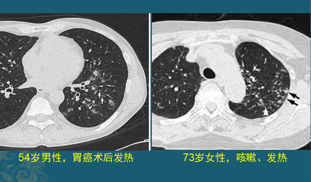 碘酒过期了还能用吗，过期了的碘酒还能不能用（硬扛3天不吃抗生素必后悔）