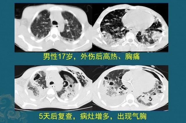 碘酒过期了还能用吗，过期了的碘酒还能不能用（硬扛3天不吃抗生素必后悔）