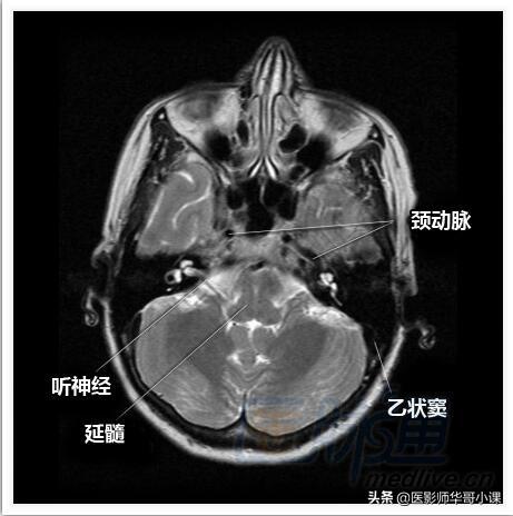 颅脑mri(头部MRI)插图(1)