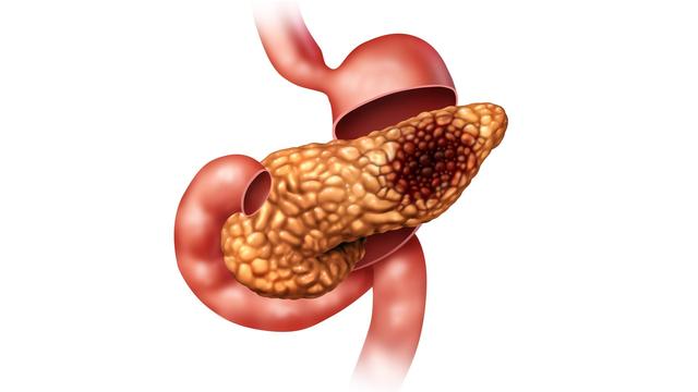 胰脏是什么，胰脏是什么番（还有4类主要原因）