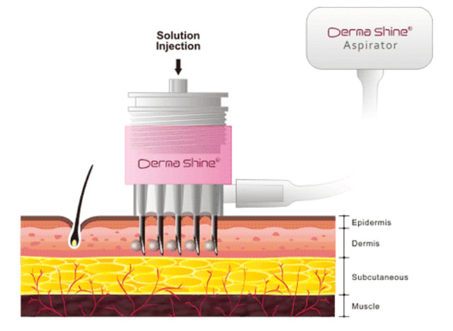 英诺小棕瓶多久打一次为最佳（火出圈的“水光针”市场乱象不止）