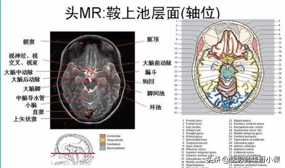 颅脑mri(头部MRI)插图(75)