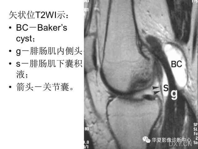 膝关节解剖结构图，膝盖解剖图示意图（膝关节MRI之正常解剖综述）