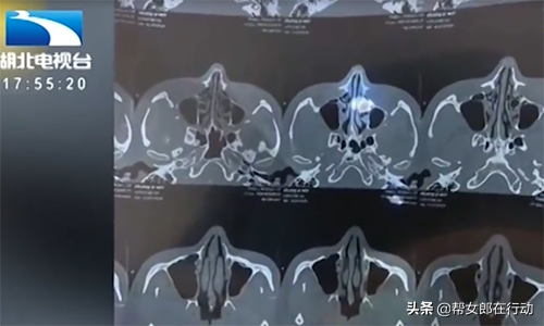 鼻部整容多少钱，整鼻多少钱（小伙花4万整容成鼻畸形）
