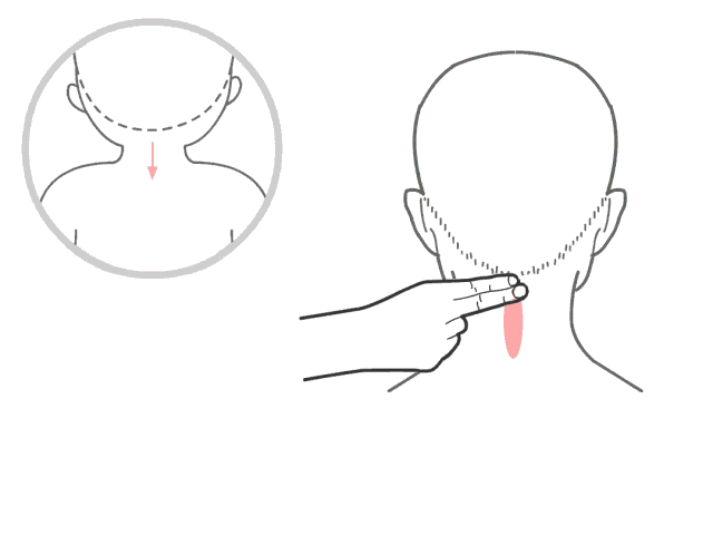 扁桃体肿大怎么办，成人扁桃体肿大怎么办（，“发热”——带你认识扁桃体的三度肿大）