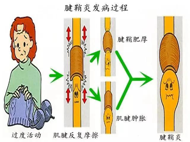 腱鞘炎怎么读，腱鞘的“鞘”怎么念