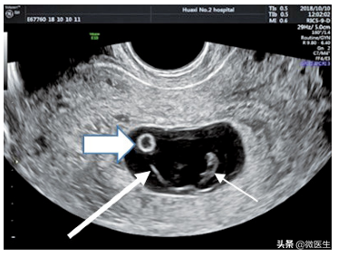 双环征是什么意思，可见双环征是什么意思（让孕妈头大的孕期B超图怎么看）