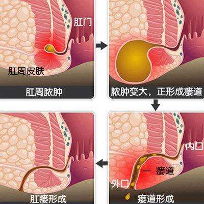 女婴肛门肉芽图片图片