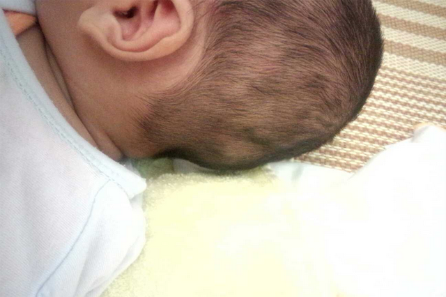 婴儿后脑勺枕骨突出图片，婴儿后脑勺太突出要怎么调整（新手妈妈吓得要去医院）