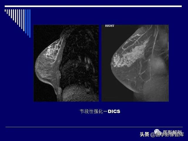 乳房解剖学基础知识，乳腺解剖及乳腺各病变影像诊断与鉴别