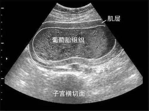 什么是葡萄胎，什么是葡萄胎图片 早期症状（准妈妈怎样尽早发现）