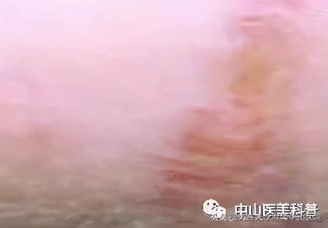 水痘坑手术缝合案例（爱美）