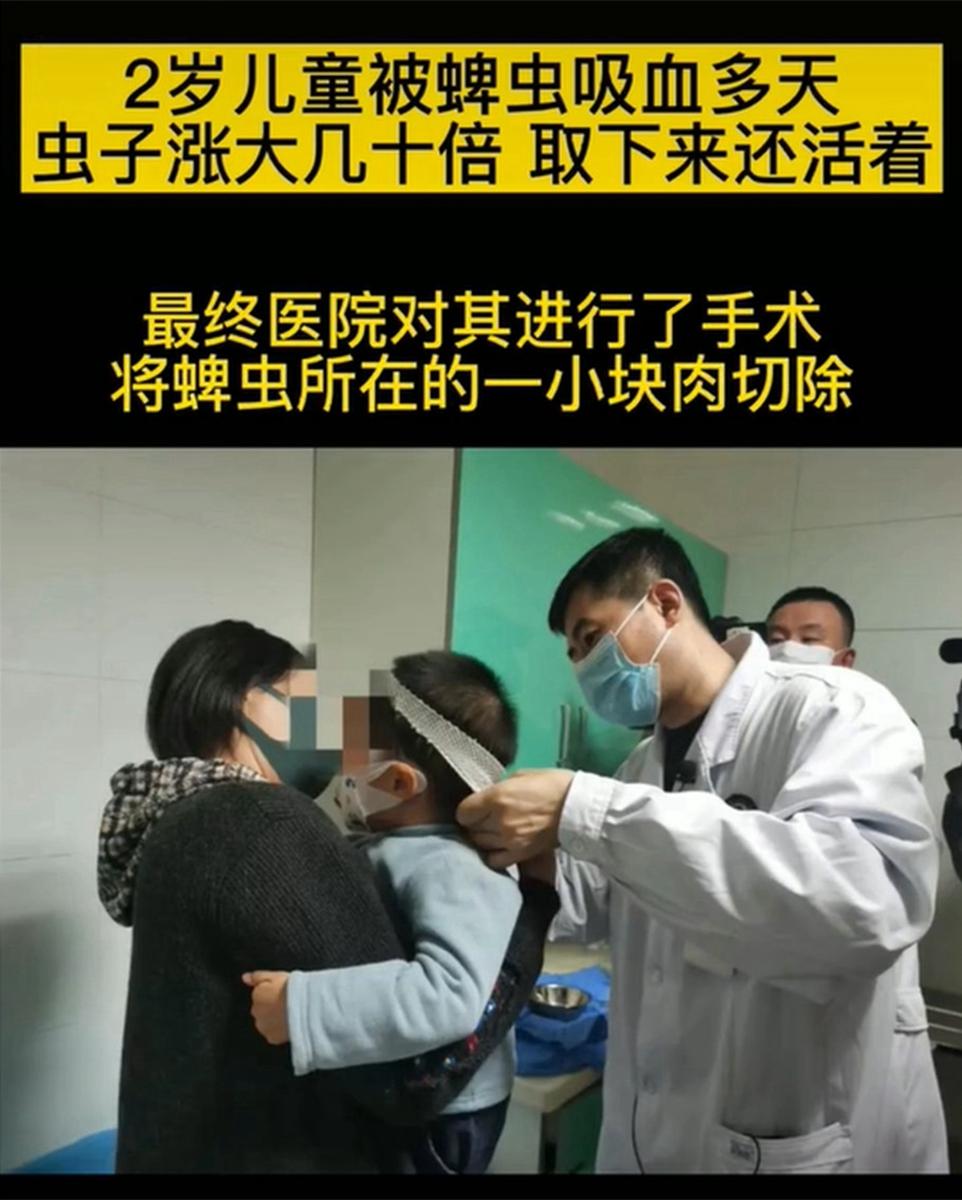 宝宝被螨虫咬的图片，宝宝为什么容易被螨虫叮咬（2岁孩子被蜱虫咬差点出事）