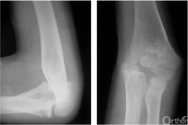 肱骨长是什么意思，骨科常见疾病X线解析之肱骨内髁骨折