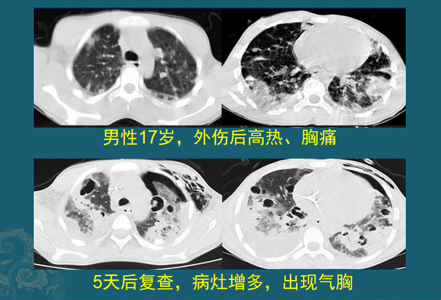 碘酒过期了还能用吗，过期了的碘酒还能不能用（硬扛3天不吃抗生素必后悔）