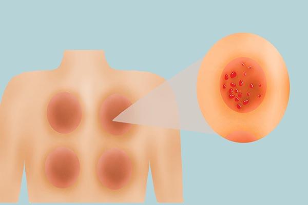 拔罐后罐印图片配图解，女性拔罐罐印图解（皮肤会有一块块印记）