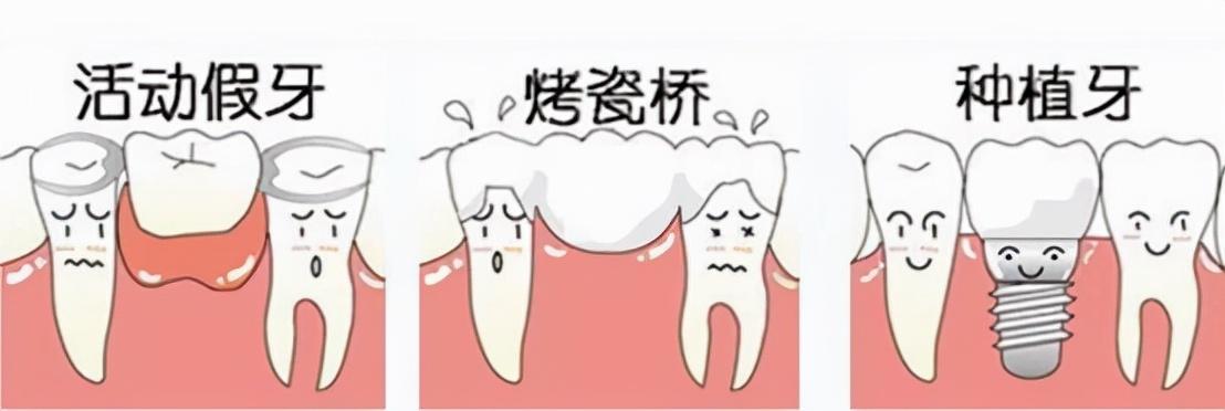 良心医生不建议种植牙镶牙,为什么60岁后不种植牙
