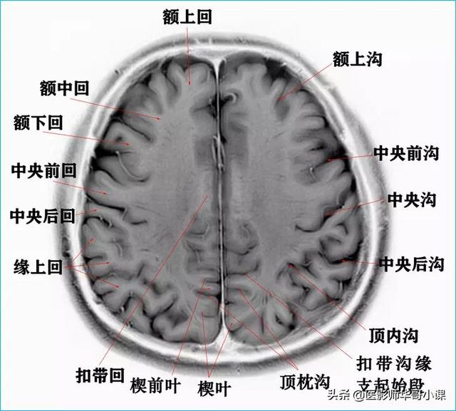 头颅ct解剖图，头部骨骼结构图（颅脑磁共振MRI解剖结构以及高清图谱）