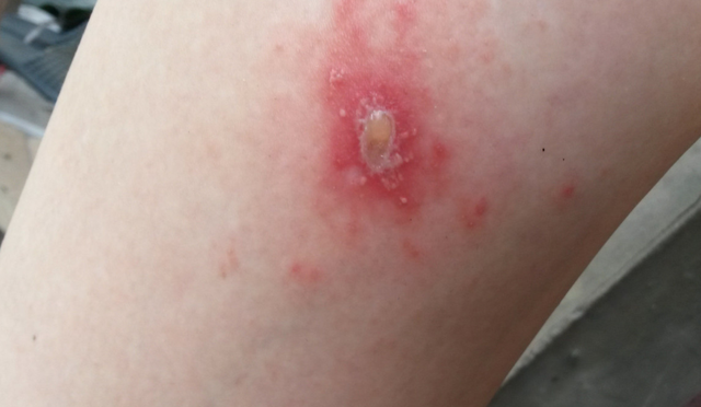 隐翅虫在床上爬了还能睡吗，家里为什么会有隐翅虫（妈妈用3分钟处理法救了娃）