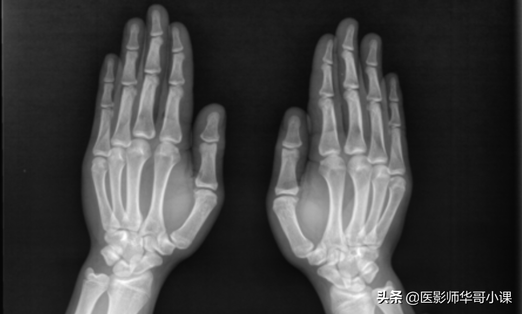 尺骨桡骨怎么区分，怎样分辨尺骨和桡骨（骨关节记忆要点，请收藏）