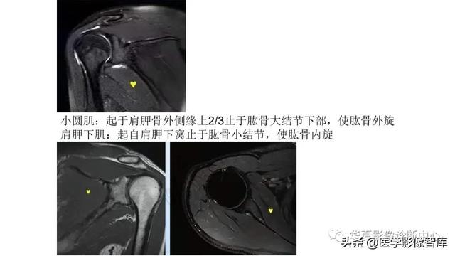 肩关节骨标志解剖图，全面掌握肩关节解剖