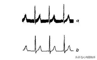 胸骨左缘第五肋间隙下两厘米的地方是她，我把她藏在心跳最剧烈的地方。，你是我放在胸骨左缘第五肋间隙的人（来看看这些需要注意的细节图片）