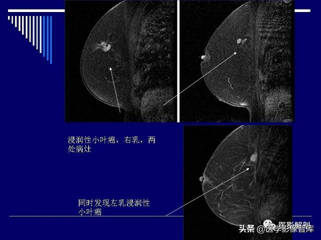 乳房解剖学基础知识，乳腺解剖及乳腺各病变影像诊断与鉴别