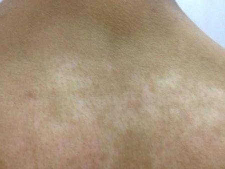 普通白斑图片大全，普通白斑图片及原因（不是所有的白斑都是白癜风）