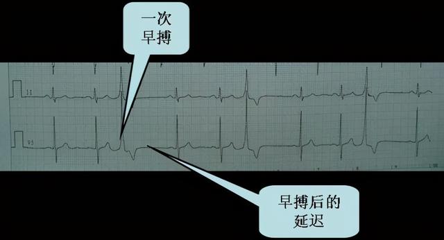 窦性心律是什么意思，窦性心律是什么意思有危险吗（什么是窦性心律）