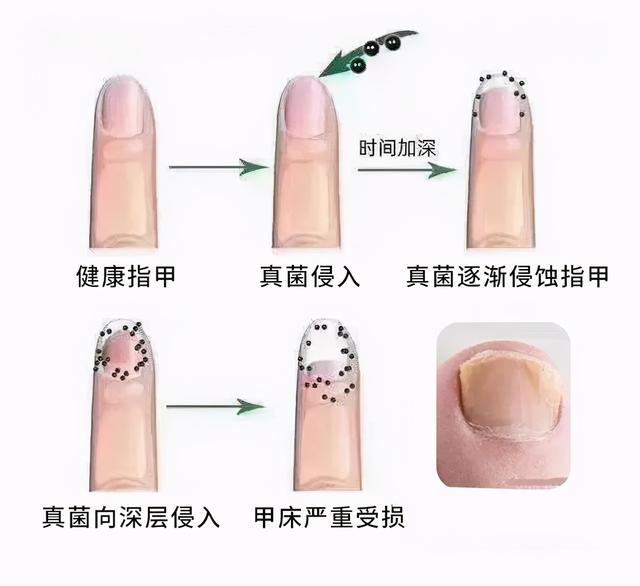 灰指甲传染吗一般多长时间，得了灰指甲
