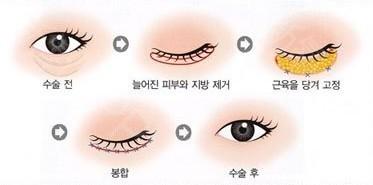 眼袋下面的纹是什么纹，为什么眼睛下面有眼袋纹（你又知道这黑三角是哪吗）