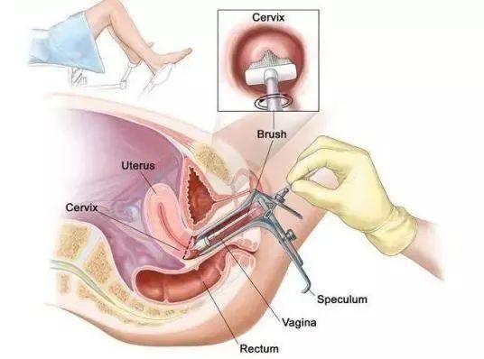 四价hpv疫苗(宫颈癌预防攻略) - 乐宝宝贝