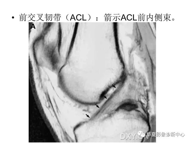 膝关节解剖结构图，膝盖解剖图示意图（膝关节MRI之正常解剖综述）