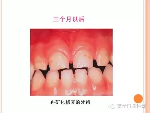 氟对牙齿的作用，含氟牙膏对牙齿的作用（有牙就要开始涂氟）
