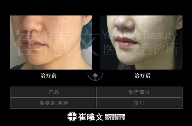 瘦脸针能溶脂针吗，瘦脸针和溶脂针可以同时打吗（瘦脸针也可以量身定制哦！）