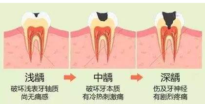 龋齿是什么样子的图片(龋齿是什么牙齿)插图(5)