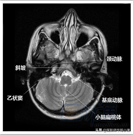 颅脑mri(头部MRI)插图